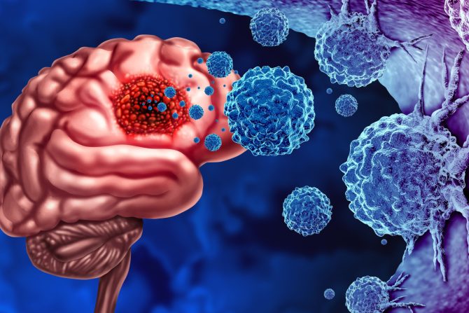 Tumor na mozgu