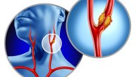 Karotidna arterija kao uzrok bola u vratu: Kada je potrebno potražiti hitnu medicinsku pomoć