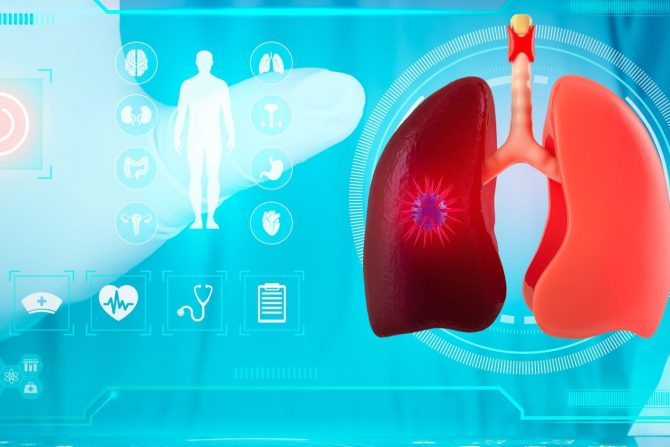 rak pluća kod nepušača