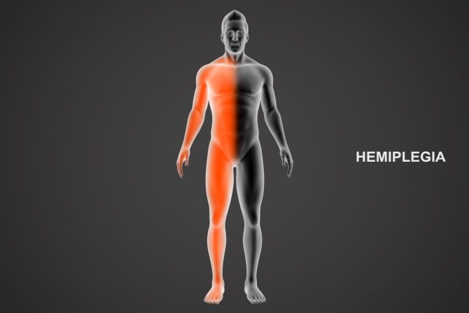 hemiplegija