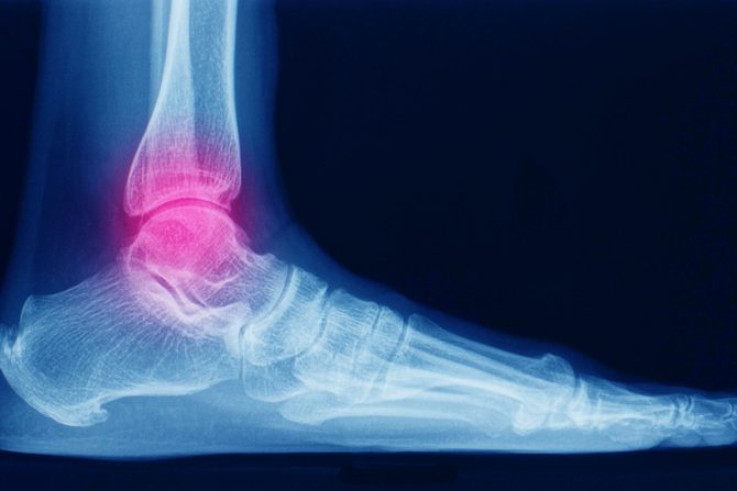 Oslanjanje na skočni zglob