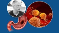 Dr Dino Tarabar: Ove simptome raka želuca mnogi ljudi ignorišu, a mogu da nam sačuvaju glavu