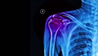 Kalcifikacija ramena uglavnom se slučajno otkriva, lekari savetuju kako treba da se leči