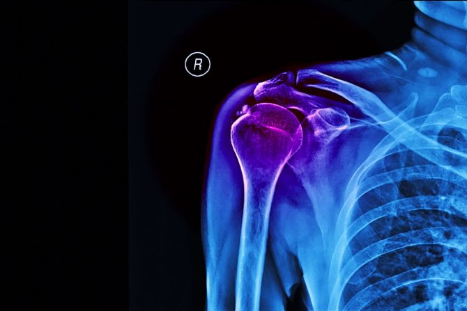 kalcifikacija ramena