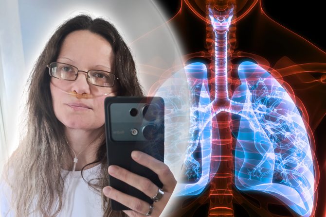 Plućna fibroza Ana Horeš