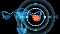 Na koje organe se prvo širi rak jajnika i šta određuje stadijum kancera: Od ovih stavki zavisi tok bolesti, lečenje i prognoza
