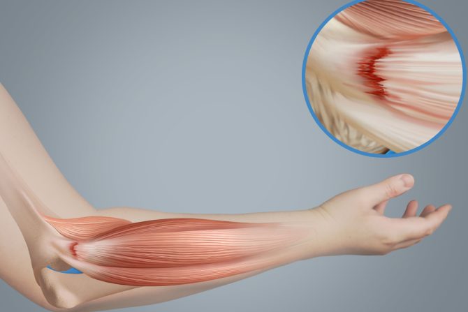 Bol u laktu teniski lakat