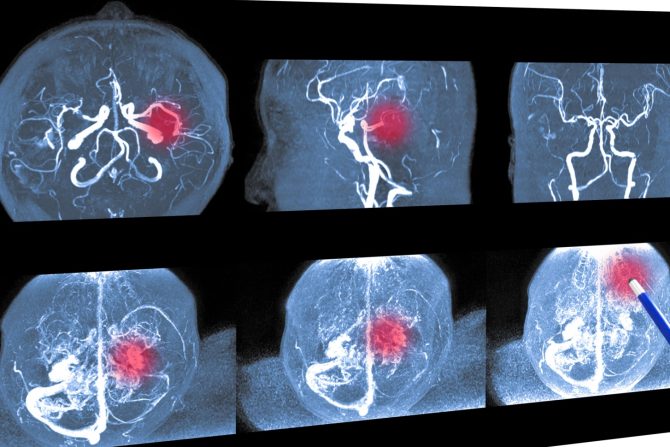 novi lek za moždani udar