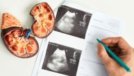 Otkazivanje bubrega: Tiha opasnost koja ugrožava zdravlje – Put od prvih simptoma do borbe za život