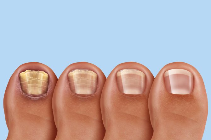 gljivične infekcije noktiju