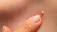 Koliko su papilomi na koži opasni i da li se šire ako otkinemo bradavicu