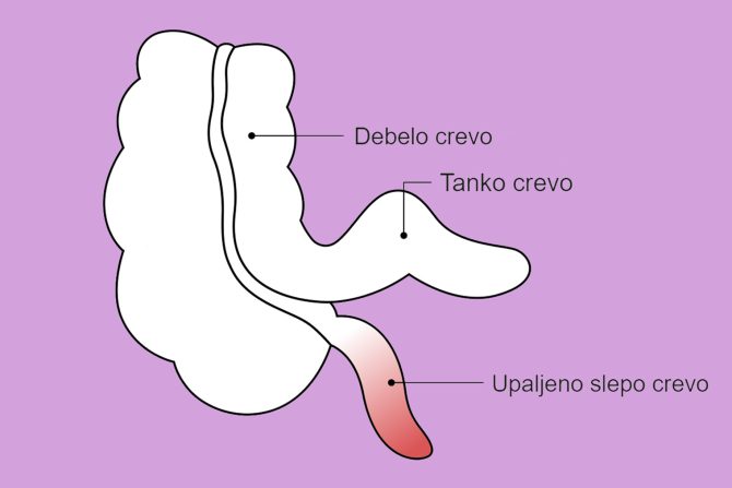 operacija slepog creva