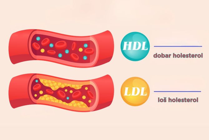 loš holesterol