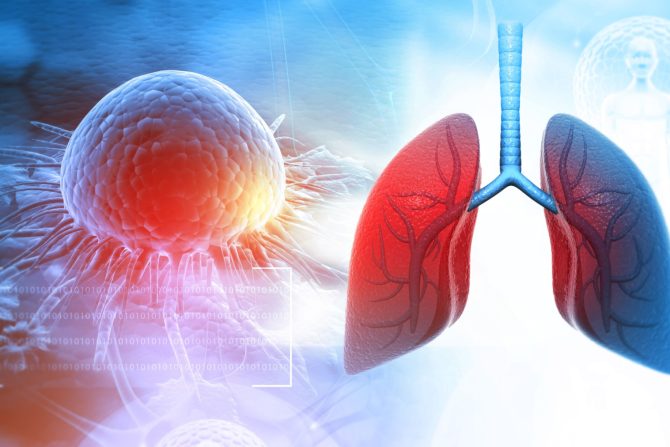 Karcinom pluća