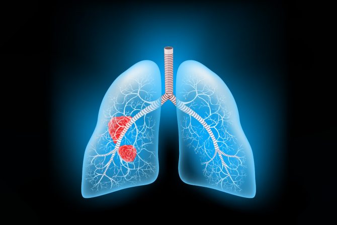 rak pluća