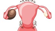 Šta su čokoladne ciste: Kakve veze imaju sa endometriozom i kako utiču na plodnost