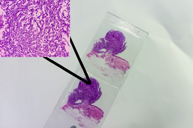 Skvamozni karcinom kože