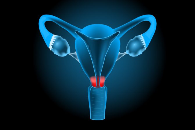 rak grlića materice