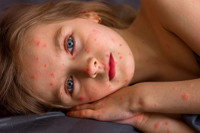 morbile male boginje