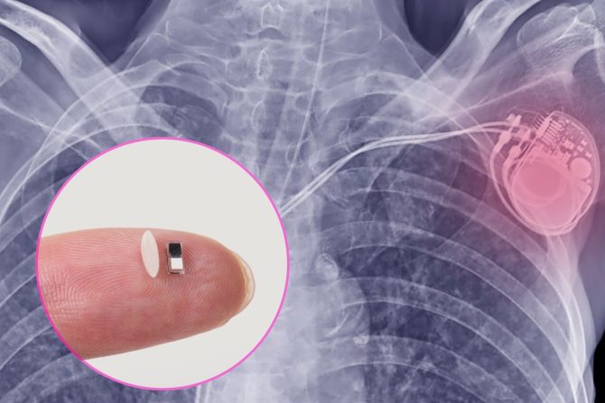 najmanji pejsmejker na svetu