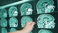 Metastaze na mozgu odlično kontroliše i rešava jedna minimalno invazivna metoda, kažu rezultati dvadesetogodišnje studije
