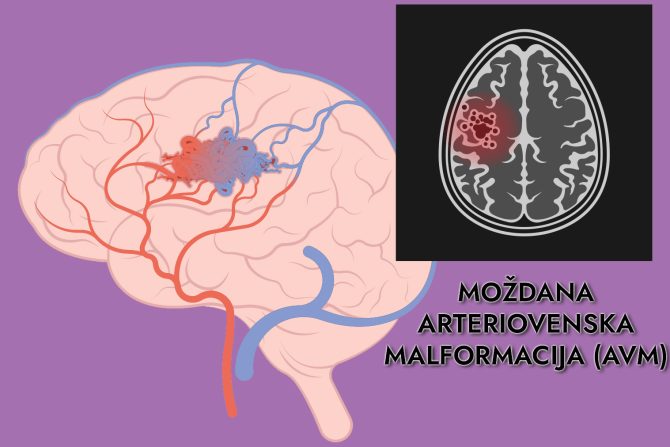 moždana arteriovenska malformacija