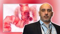 Kolorektalni karcinom sa metastazama: Kako do dužeg preživljavanja, odgovara hirurg Nebojša Stojaković