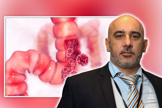 Kolorektalni karcinom Stojaković