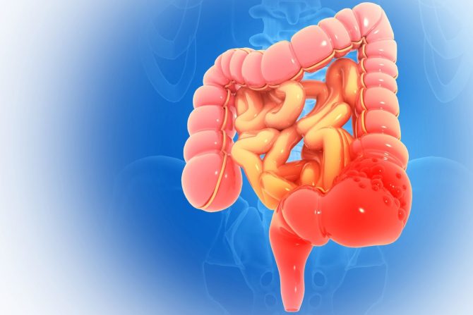 neizlečiv rak creva