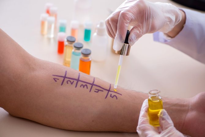 alergija na histamin