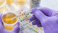 Jednostavan test urina mogao bi da otkrije rak prostate već u početnoj fazi