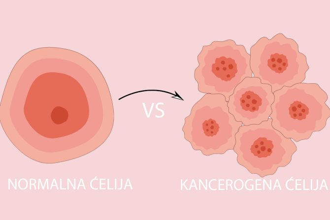 nedijagnostikovan karcinom