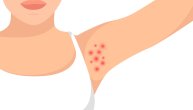 Folikulitis: Simptomi, uzroci, dijagnoza i lečenje