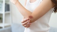 Krv se ponekad ne zgrušava dobro zbog manjka jednog proteina: Ako lako dobijate modrice, možda je uzrok hemofilija B