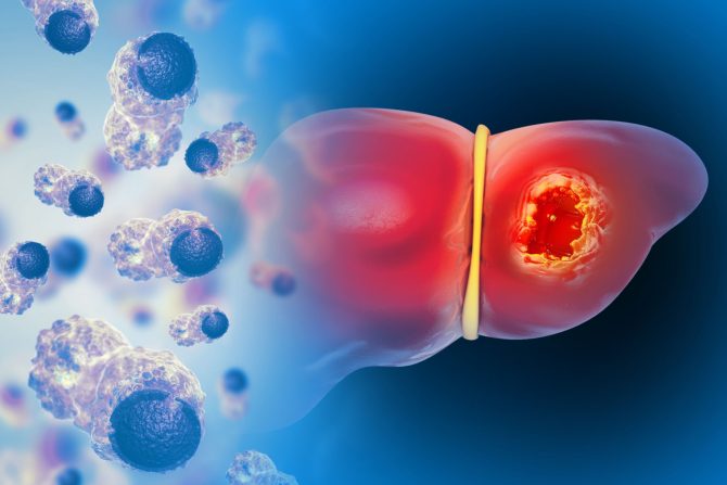 Hepatocelularni karcinom jetre
