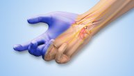 Bol u ruci zbog kog ne spavate, trnu vam prsti i ispadaju stvari: Dr Todorović objašnjava kako se leči sindrom karpalnog tunela
