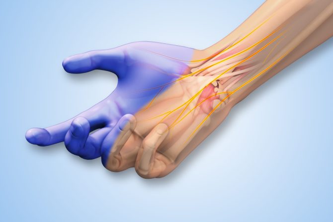 Sindrom karpalnog tunela/kanala
