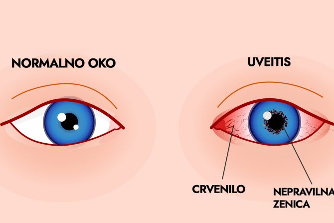 uveitis