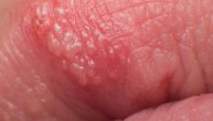 Virus koji izaziva herpes povećava rizik od razvoja Alchajmerove bolesti