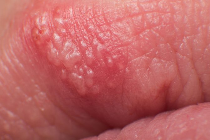 virus herpes simplex 1 (HSV-1)