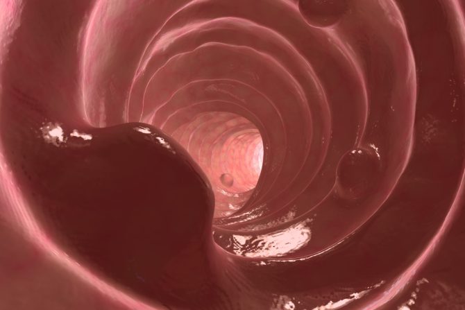 oboleli od raka debelog creva