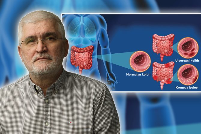 Zapaljenske bolesti creva