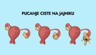 Specifičan bol poručuje da je pukla cista na jajniku, ali to se može desiti i bez simptoma