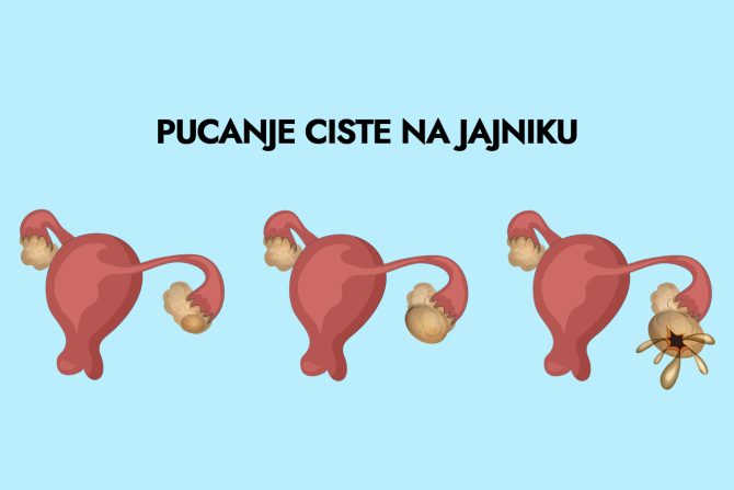 Pucanje ciste na jajniku