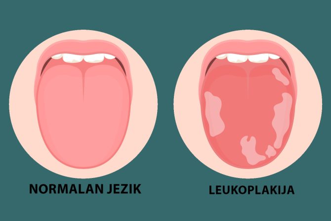leukoplakija