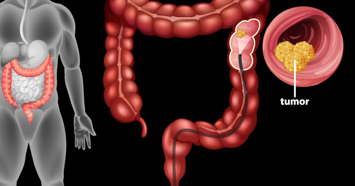 Rak Debelog Creva Simptomi Koje Ne Smete Ignorisati Kada Treba