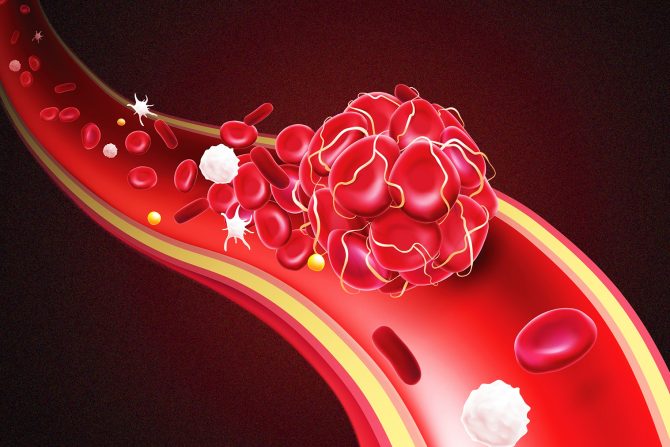 visok krvni pritisak