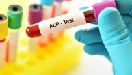Enzim koji otkriva bolesti jetre i kostiju: Šta znači kada su vrednosti alkalne fostaze (ALP) niske ili visoke
