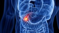 Simptomi kamena ili upale slični su i kada se razvije rak žučne kese: Evo na šta treba obratiti pažnju