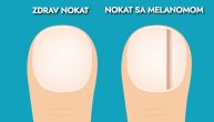 Ovako izgleda melanom nokta: Prepoznajte gotovo nevidljive znake opasne bolesti koji mogu da zavaraju